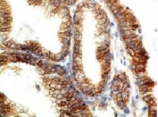 Formalin-fixed, paraffin-embedded human colon carcinoma stained with E-Cadherin antibody (CDH1/1525).