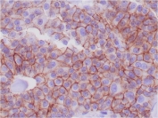 Formalin-fixed, paraffin-embedded human breast adenocarcinoma stained with E-Cadherin antibody (CDH1/1525).