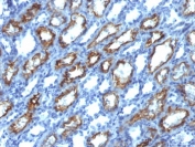 IHC testing of FFPE human renal cell carcinoma with IFN gamma antibody (clone IFNG/466). Required HIER: boil tissue sections in 10mM Tris with 1mM EDTA, pH 9.0, for 10-20 min.