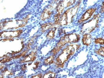 IHC testing of FFPE human renal cell carcinoma with IFN gamma antibody (clone IFNG/466). Required HIER: boil tissue sections in 10mM Tris with 1mM EDTA, pH 9.0, for 10-20 min.~