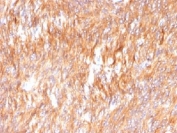 IHC testing of FFPE human small intestine carcinoma with Calnexin antibody. HIER: boil tissue sections in 10mM Tris with 1mM EDTA, pH 9.0 for 10-20 min.