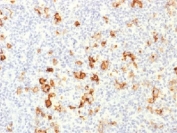 IHC testing of FFPE human Hodgkin's lymphoma with CD15 antibody. Required HIER: boil tissue sections in 10mM Tris with 1mM EDTA, pH 9, for 10-20 min.