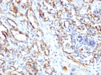 IHC staining of FFPE human angiocarcinoma with CD31 antibody. HIER: steam sections in pH7.5-8.5, 1mM EDTA for 10-20 min.~