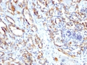 IHC staining of FFPE human angiocarcinoma with CD31 antibody. HIER: steam sections in pH7.5-8.5, 1mM EDTA for 10-20 min.