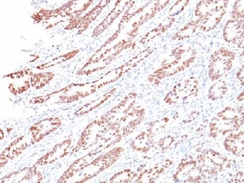 IHC testing of human colon with Rb antibody (clone 1F8). Required HIER: boil tissue sections in 10mM citrate buffer, pH 6, for 10-20 min followed by cooling at RT for 20 min.~