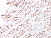 IHC testing of human colon with Rb antibody (clone 1F8). Required HIER: boil tissue sections in 10mM citrate buffer, pH 6, for 10-20 min followed by cooling at RT for 20 min.