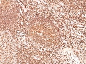 IHC staining of FFPE human tonsil tissue with CD45 antibody (clone F10-89-4). HIER: boil tissue sections in pH 9 10mM Tris with 1mM EDTA for 20 min and allow to cool before testing.