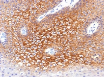 IHC testing of FFPE human cervical carcinoma with Plakoglobin antibody (clone CTNG/1483). Required HIER: boil tissue sections in 10mM Tris with 1mM EDTA, pH 9, for 10-20 min.~