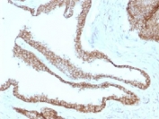 IHC testing of FFPE human prostate carcinoma with Gamma Catenin antibody (clone CTNG/1483). Required HIER: boil tissue sections in 10mM Tris with 1mM EDTA, pH 9, for 10-20 min.