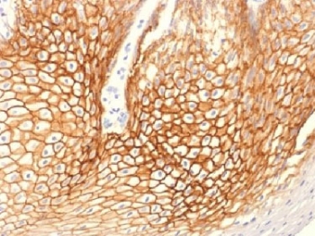 IHC testing of FFPE human cervical carcinoma with Gamma Catenin antibody (clone CTNG/1483). Required HIER: boil tissue sections in 10mM Tris with 1mM EDTA, pH 9, for 10-20 min.~
