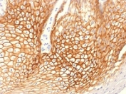 IHC testing of FFPE human cervical carcinoma with Gamma Catenin antibody (clone CTNG/1483). Required HIER: boil tissue sections in 10mM Tris with 1mM EDTA, pH 9, for 10-20 min.