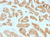 IHC testing of FFPE human prostate carcinoma with AMACR antibody (clone AMACR/1723). HIER: boil tissue sections in pH 9 10mM Tris with 1mM EDTA for 20 min and allow to cool before testing.