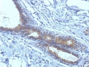 IHC testing of FFPE human breast carcinoma tissue with BRCA1 antibody (clone BRCA1/1398). HIER: boil tissue sections in 10mM citrate buffer, pH 6.0, for 10-20 min.