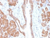 IHC testing of FFPE human pancreas tissue with Beta Catenin antibody (clone CTNNB1/1508). Required HIER: boil tissue sections in 10mM Tris with 1mM EDTA, pH 9.0, for 10-20 min.