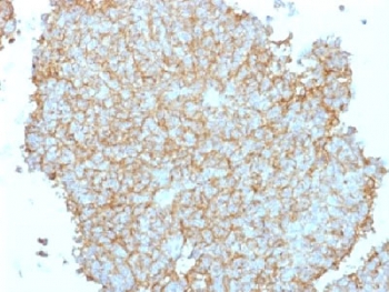 IHC testing of FFPE human Ewing's sarcoma with CD99 antibody. Required HIER: steam sections in 10mM citrate buffer, pH 6.0, for 10-20 min.
