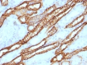 IHC testing of FFPE human renal cell carcinoma with Cadherin 16 antibody. Required HIER: steam sections in 10mM Tris with 1mM EDTA, pH 9, for 10-20 min.