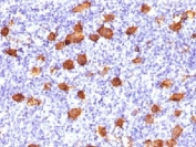 IHC testing of FFPE human Hodgkin's lymphoma stained with CD30 antibody. Required HIER: steam sections in pH9, 1mM EDTA for 10-20 min.
