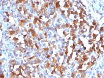 IHC testing of FFPE human melanoma stained with MART-1 antibody. HIER: steam sections in pH 9 10mM Tris with 1mM EDTA for 10-20 min.~