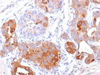 IHC testing of FFPE human breast carcinoma with PIP antibody (clone PIP/1571). Required HIER: boil tissue sections in 10mM Tris with 1mM EDTA, pH 9, for 10-20.~