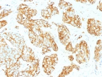 IHC testing of FFPE human prostate carcinoma with CD44v9 antibody