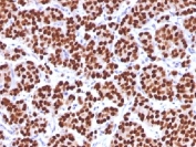 IHC testing of FFPE human prostate carcinoma with FOXA1 antibody (clone FOXA1/1512). HIER: boil sections in 10mM Tris with 1mM EDTA, pH9, for 10-20 min.
