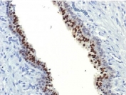 IHC testing of FFPE human prostate carcinoma with FOXA1 antibody (clone FOXA1/1514). HIER: boil sections in 10mM Tris with 1mM EDTA, pH9, for 10-20 min.