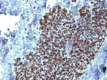 IHC testing of FFPE human prostate carcinoma with FOXA1 antibody (clone FOXA1/1514). HIER: boil sections in 10mM Tris with 1mM EDTA, pH9, for 10-20 min.~