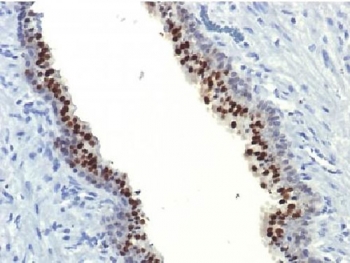 IHC testing of FFPE human prostate carcinoma with FOXA1 antibody (clone FOXA1/1514)