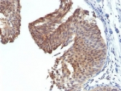 IHC testing of FFPE human bladder carcinoma with Cytokeratin 6 antibody (clone KRT6/1702). Required HIER: boil tissue sections in 10mM citrate buffer, pH 6, for 10-20 min.