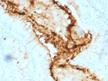 IHC testing of FFPE human colon carcinoma with Lewis y antibody (clone A70-A/A9). Required HIER: boil tissue sections in 10mM citrate buffer, pH 6, for 10-20 min.~