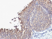 IHC testing of FFPE human bladder carcinoma with Cytokeratin 10 antibody (clone SPM623). Required HIER: boil tissue sections in pH 9 10mM Tris with 1mM EDTA for 10-20 min.