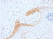 IHC testing of FFPE human basal cell carcinoma with Cytokeratin 15 antibody (clone KRT15/1699). Required HIER: boil tissue sections in 10mM citrate buffer, pH 6, for 10-20 min.