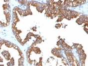IHC analysis of FFPE human prostate carcinoma with Cytokeratin 8/18 antibody (clone 5D3). Required HIER: boil tissue sections in pH 9 10mM Tris with 1mM EDTA for 10-20 min.
