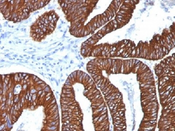 IHC analysis of FFPE human colon carcinoma with Cytokeratin 8/18 antibody (clone 5D3). Required HIER: boil tissue sections in pH 9 10mM Tris with 1mM EDTA for 10-20 min.~
