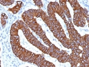IHC analysis of FFPE human colon carcinoma with Cytokeratin 8/18 antibody (clone KRT8.18/1346). Required HIER: boil tissue sections in pH 9 10mM Tris with 1mM EDTA for 10-20 min.