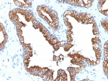 IHC analysis of FFPE human prostate carcinoma with Cytokeratin 8/18 antibody (clone KRT8.18/1346). Required HIER: boil tissue sections in pH 9 10mM Tris with 1mM EDTA for 10-20 min.~