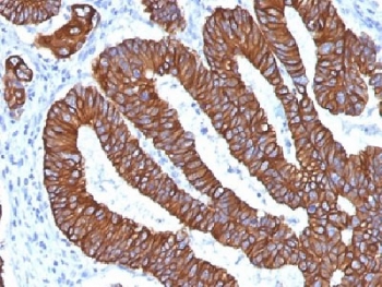 IHC analysis of FFPE human colon carcinoma with Cytoke