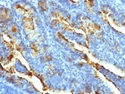 IHC testing of FFPE human uterine carcinoma with FSHR antibody (clone FSHR/1400). Required HIER: boil tissue sections in 10mM Tris with 1mM EDTA, pH 9, or 10mM citrate buffer, pH6, for 10-20 min.