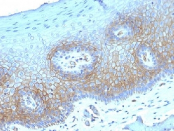 IHC testing of FFPE human cervical carcinoma with Thrombomodulin antibody (clone THBD/1782). HIER: boil tissue sections in 10mM Tris buffer with 1mM EDTA, pH 9, for 10-20 min followed by cooling at RT for 20 min.~