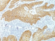 IHC testing of FFPE human lung squamos cell carcinoma with Desmoglein 3 antibody (clone DSG3/1535). Required HIER: boil tissue sections in 10mM citrate buffer, pH 6, for 10-20 min.