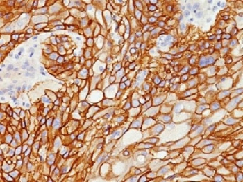 IHC testing of FFPE human lung squamous cell carcinoma with EGF Receptor antibody (clone GFR/1708). Required HIER: boiling tissue sections in 10mM citrate buffer, pH 6, for 10-20 min.~