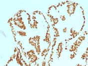 IHC testing of FFPE human prostate carcinoma with FOXA1 antibody (clone FOXA1/1515). HIER: boil sections in 10mM Tris with 1mM EDTA, pH9, for 10-20 min.
