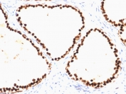 IHC testing of FFPE human prostate carcinoma with FOXA1 antibody (clone FOXA1/1515). HIER: boil sections in 10mM Tris with 1mM EDTA, pH9, for 10-20 min.