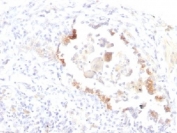 IHC testing of FFPE human lung carcinoma with Lewis y antibody (clone LWY/1463). Required HIER: boil tissue sections in 10mM citrate buffer, pH 6, for 10-20 min.