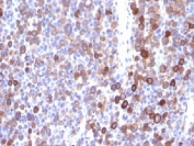 IHC testing of FFPE human melanoma with Moesin antibody (clone MSN/491). Required HIER: boil tissue sections in 10mM citrate buffer, pH 6, for 10-20 min.