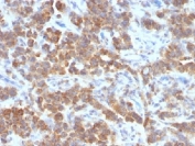 IHC testing of FFPE human parathyroid mass with TL1A antibody (clone VEGI/1283). Required HIER: boil sections in 10mM Tris with 1mM EDTA, pH9, for 10-20 min followed by cooling at RT for 20 min.