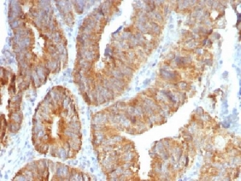 IHC testing of FFPE human colon carcinoma with TL1A antibody (clone VEGI/1283). Required HIER: boil sections in 10mM Tris with 1mM EDTA, pH9, for 10-20 min followed by cooling at RT for 20 min.~