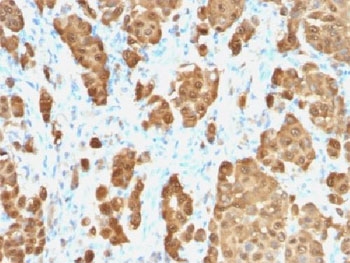 IHC testing of FFPE human melanoma with recombinant S100B antibody. HIER: steam sections in pH 9 10mM Tris with 1mM EDTA for 10-20 min.