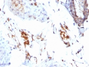 IHC staining of FFPE human testicular carcinoma with Ferritin Light Chain antibody (clone FTL/1386). HIER: boil tissue sections in pH 9 10mM Tris with 1mM EDTA for 10-20 min and allow to cool before testing.