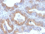 IHC testing of FFPE human ovarian carcinoma with LHR antibody (clone LHCGR/1417). Required HIER: boil tissue sections in 10mM citrate buffer, pH 6, for 10-20 min.